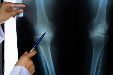 Notre blog 24 Arthrose du genou