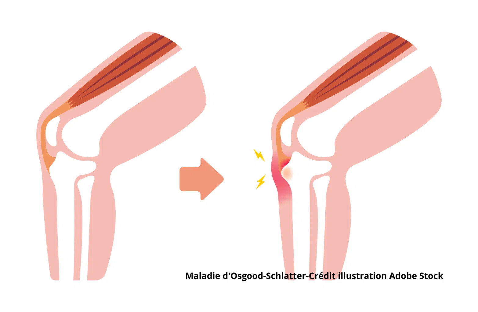 La maladie d’Osgood-Schlatter 9 Maladie d'Osgood-Schlatter