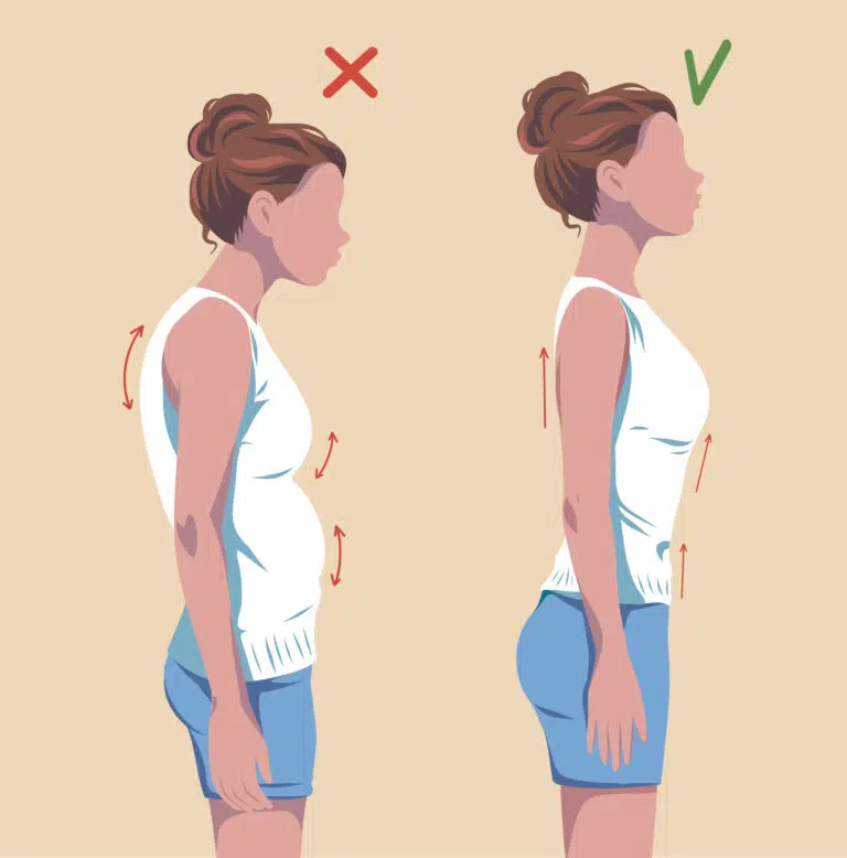 Hypercyphose dorsale