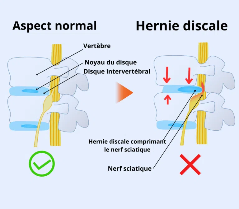 compression du nerf sciatique