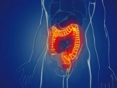 Notre blog 16 Exercice physique et intestin irritable