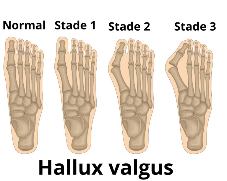 STADES HALLUX VALGUS