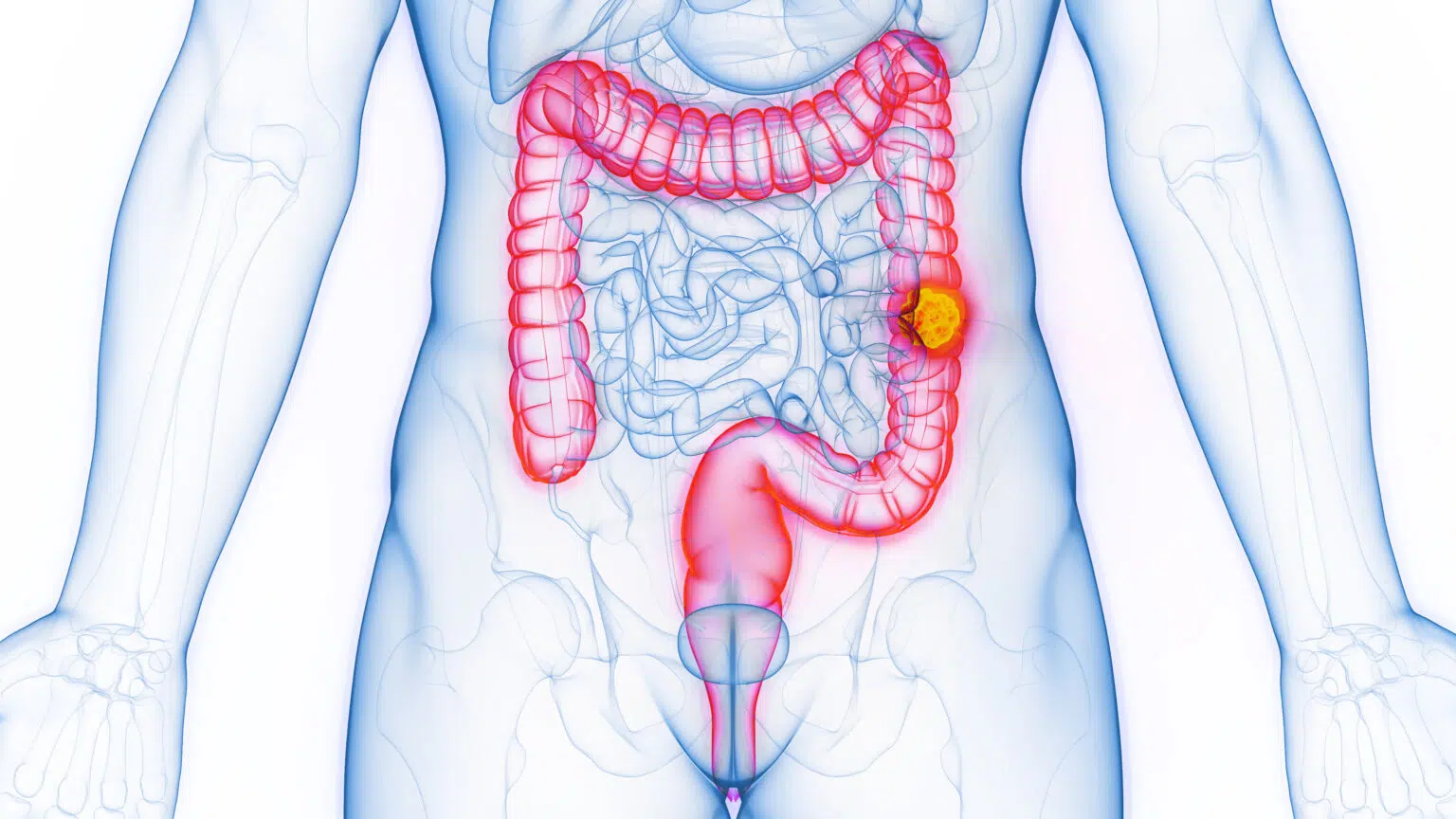 cancer du côlon : symptômes