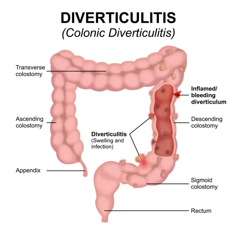 aspect diverticulite