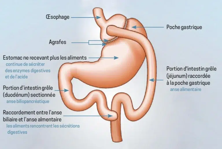 Schéma-du-bypass-gastrique-_RYGB