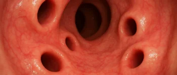Diverticulite : agir vite, mieux prévenir
