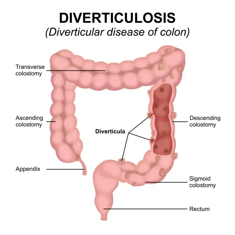 aspect diverticulose