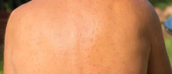 Synergie sportive: Fusionner activité physique et passions 12 Lucite estivale : prévenir l’allergie solaire