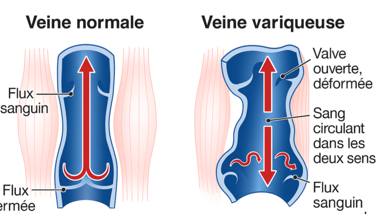 mécanisme varices