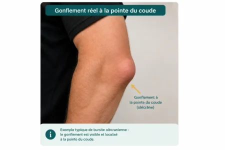 Gonflement olécrânien réel